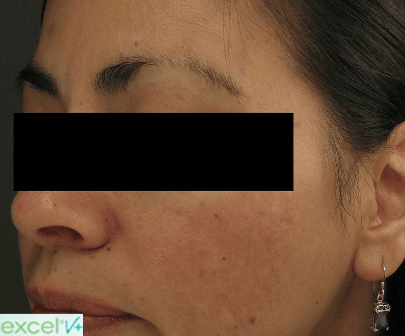 After Treatment