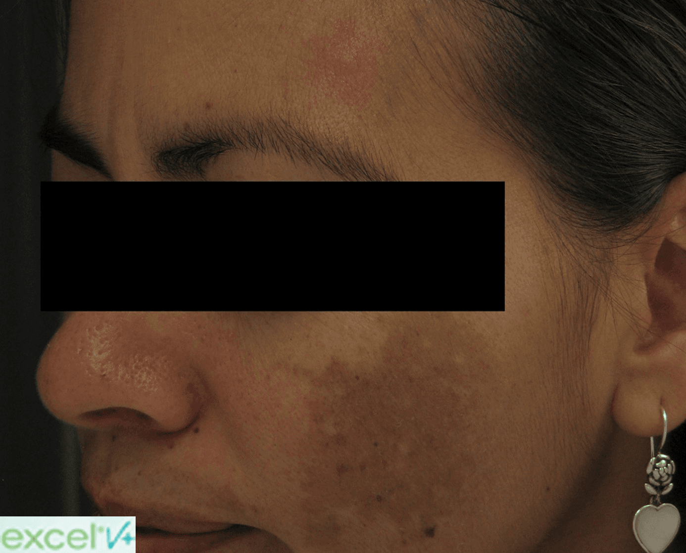 Before Treatment