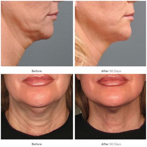 Before Ultherapy