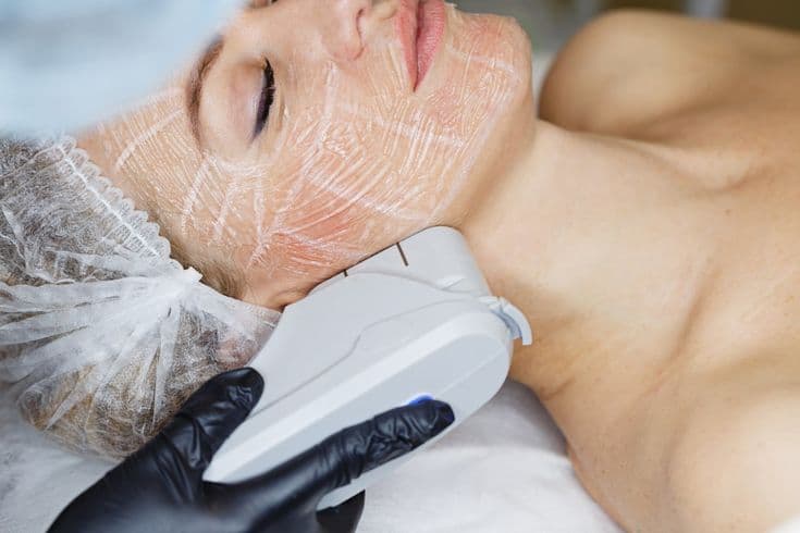 Ultherapy Treatment